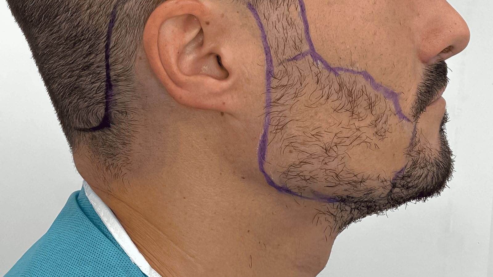 neocapilar trasplante capilar barba